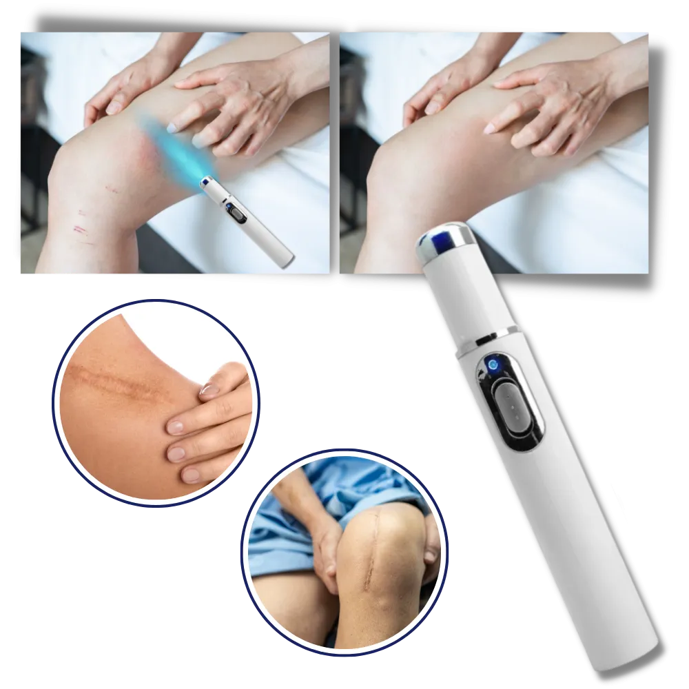 Dark Spot Remover Blue Laser Pen